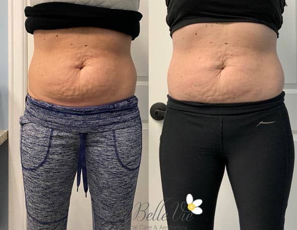 Before and after CoolSculpting: front view of a woman's lower abdomen, in gray leggings before and black leggings after, La Belle Vie watermark