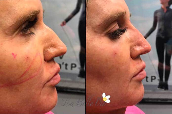 Before and after dermal filler: close side profiles of a woman's cheek, lips and chin, with injection guide lines drawn on the before photo