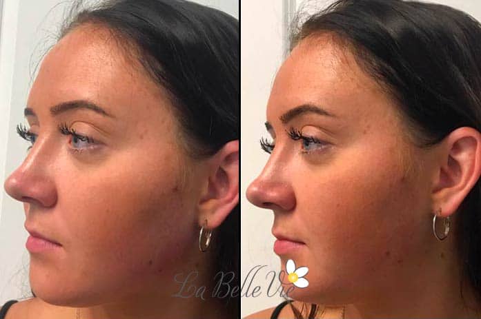 Before and after dermal filler: side-by-side three-quarter profiles of a dark-haired woman with hoop earrings, La Belle Vie watermark