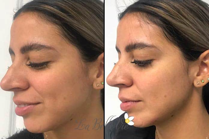 Before and after dermal filler: side-by-side three-quarter profiles of a dark-haired woman with small stud earrings, La Belle Vie watermark