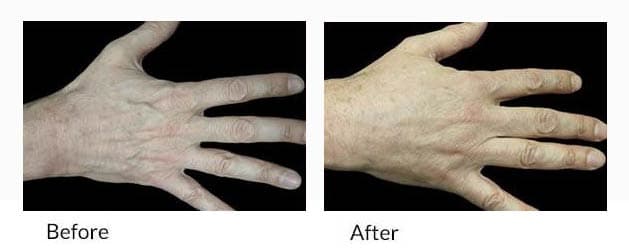 Before and after hand rejuvenation: the back of a hand on a black background, with less visible veins and tendons in the after photo