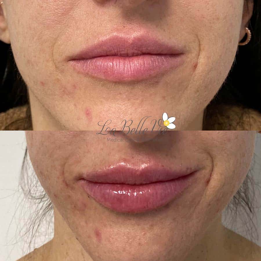 Before and after lip filler: close-up of a woman's lips, before on top and fuller after below, La Belle Vie watermark