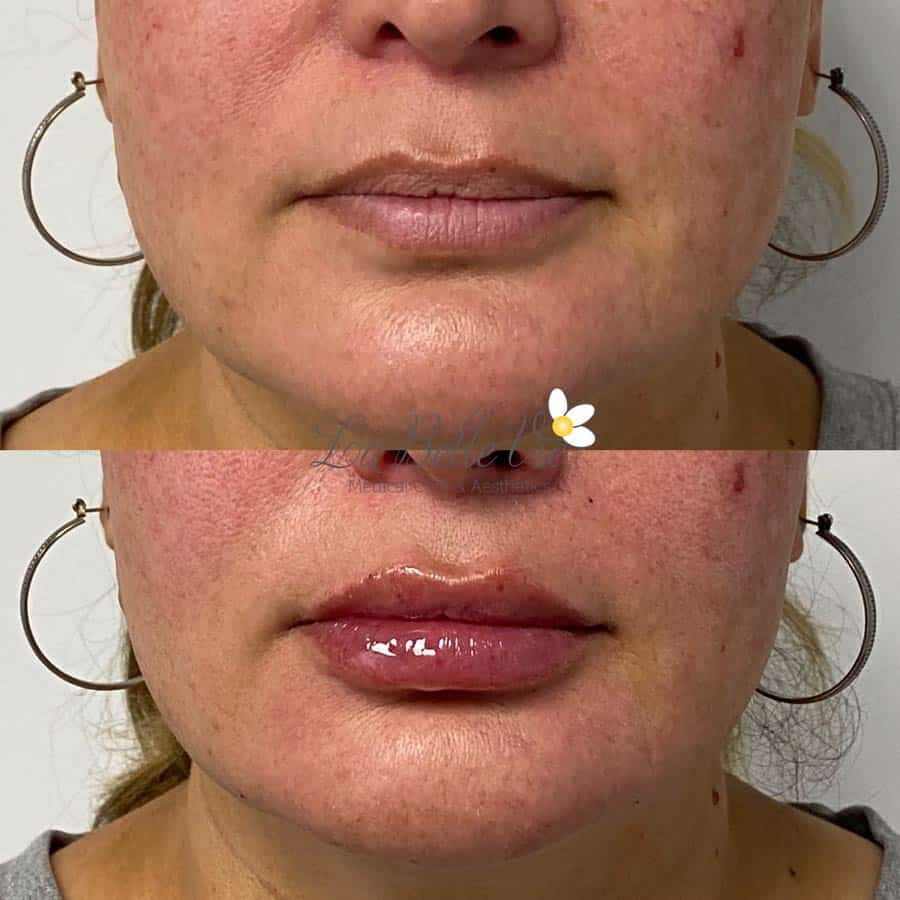 Before and after lip filler: close-up of a woman's lips and chin with hoop earrings, before on top and after below, La Belle Vie watermark