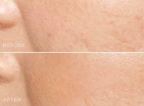 Before and after close-up of cheek skin with acne scarring, the pitted texture labeled BEFORE on top and smoother skin labeled AFTER below
