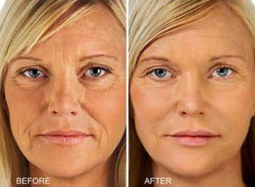 Before and after gold microneedling: front close-up of a blonde woman, with softer lines around the eyes and mouth in the photo labeled AFTER
