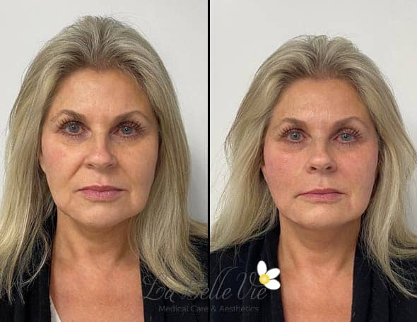 Before and after a PDO thread lift: front view of a woman with long blonde hair against a white wall, La Belle Vie watermark