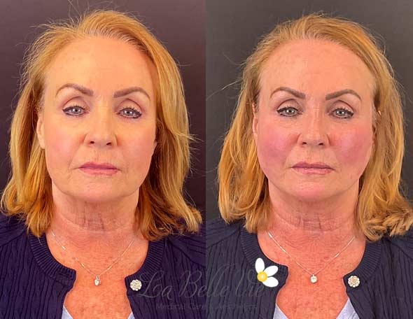 Before and after a PDO thread lift: front view of a woman with copper shoulder-length hair in a navy cardigan, La Belle Vie watermark
