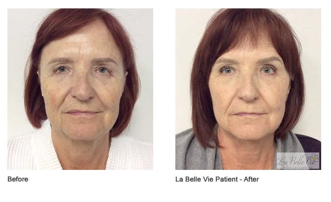 Before and after Profound RF: front view of a woman with a red bob, the after photo labeled 'La Belle Vie Patient – After'