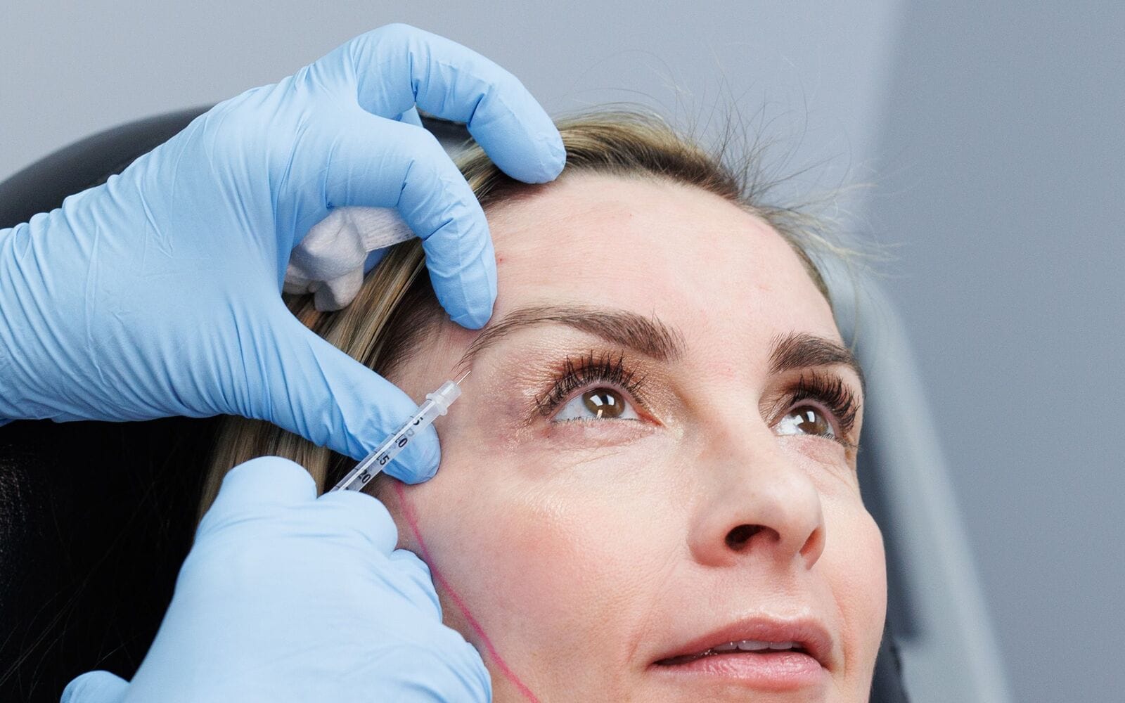 Close-up of gloved hands giving a fine-needle injection at the outer corner of a blonde patient's eye, one hand steadying her temple