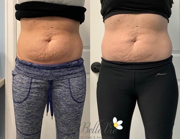 Coolsculpting before and after Photos | La Belle Vie Medical Care & Aesthetics In Draper, UT