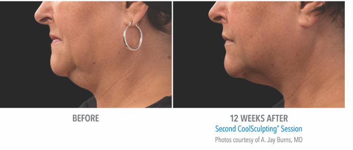 Before and after treatment photos - La Belle Vie Medical Care & Aesthetics in Draper, Utah