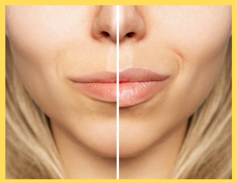 Are Lip Fillers Safe?