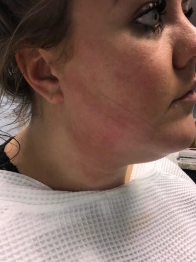 coolsculpting-chin-after