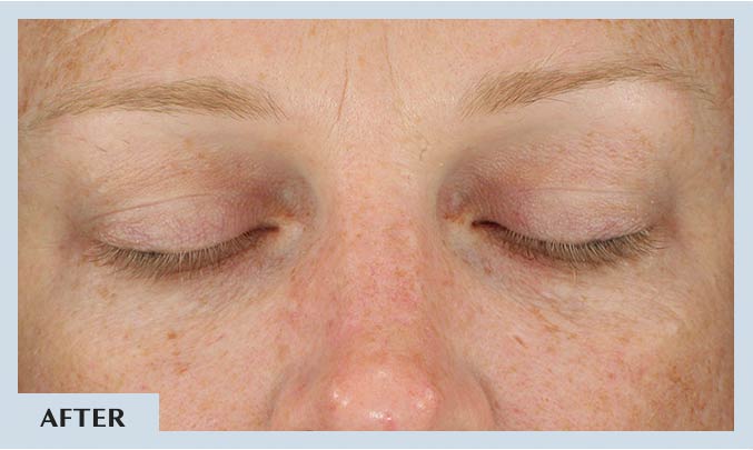 Diamond-Glow-Facial-6-weeks-After in Draper, UT | La Belle Vie Medical Care and Aesthetics