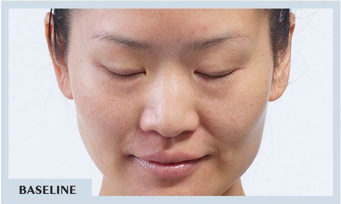Diamond-Glow-Facial-Instant-Results-Baseline | La Belle Vie Medical Care and Aesthetics