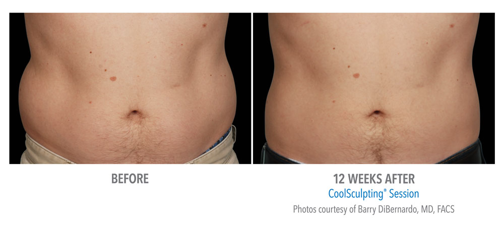 before-and-after-coolsculpting-men-abdomen
