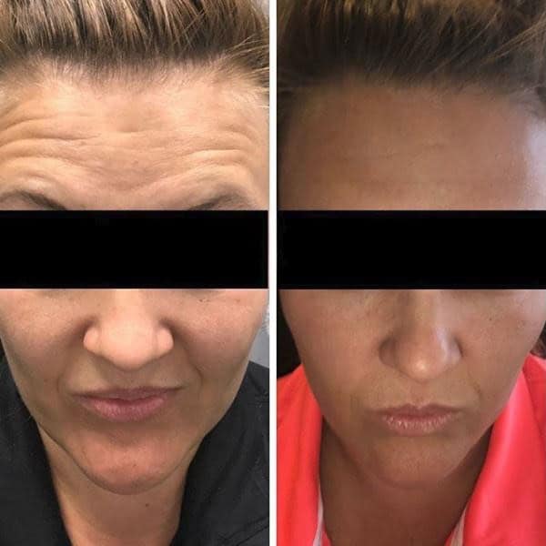 La Belle Vie Medical Care & Aesthetics offers several non-surgical treatments to minimize the appearance of fine lines and wrinkles with lasting results for a more confident and beautiful you. Give us a call today at 801-987-8384 for your BOTOX® injection consultation near Salt Lake City Botox Injection Before and After Image