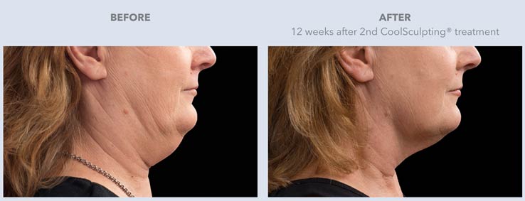 Coolsculpting-double-chin-Before & After Treatment result results in Draper, UT | La Belle Vie Medical Care and Aesthetics