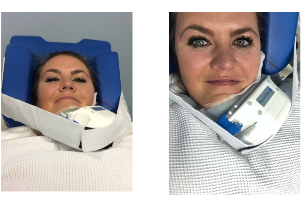 CoolSculpting Your Chin In Draper