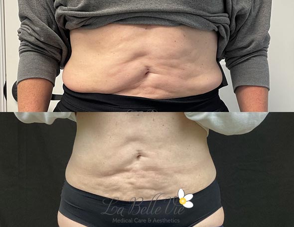 Coolsculpting before and after | La Belle Vie Medical Care & Aesthetics