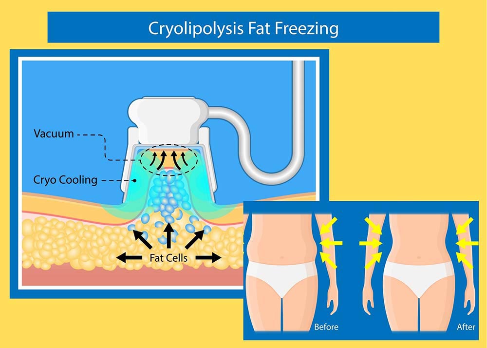 Fat freezing procedure explained