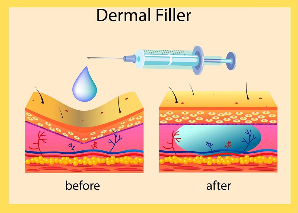 Dermal Filler procedures explained