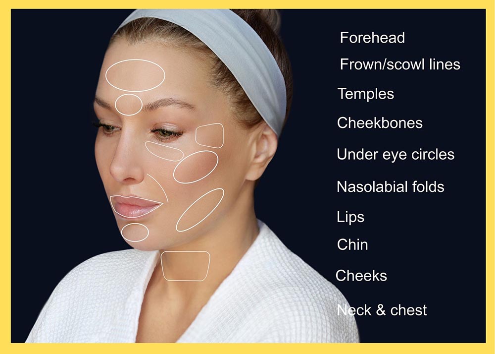 Dermal Filler treatment areas on the face and neck