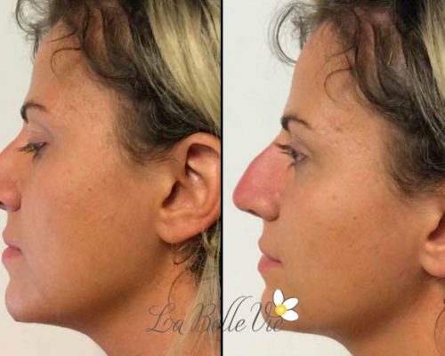 Dermal Filler Before and After Treatment Photos in Draper, UT | La Belle Vie Medical Care and Aesthetics