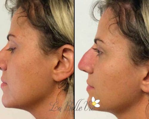 Dermal-Filler-before-and-after-6