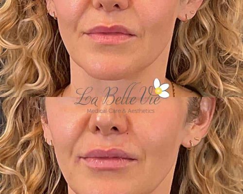 La-Belle-Vie-Lip-Pout-Before-After-12