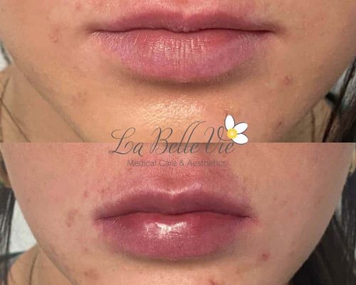 La-Belle-Vie-Lip-Pout-Before-After-Slider-1