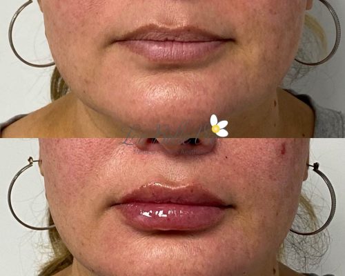 Lip Filler Before and After Photos | La Belle Vie Medical Care & Aesthetics In Draper, UT