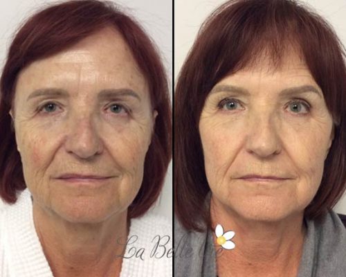 Full Liquid Facelift Before and After Photos | La Belle Vie Medical Care & Aesthetics In Draper, UT