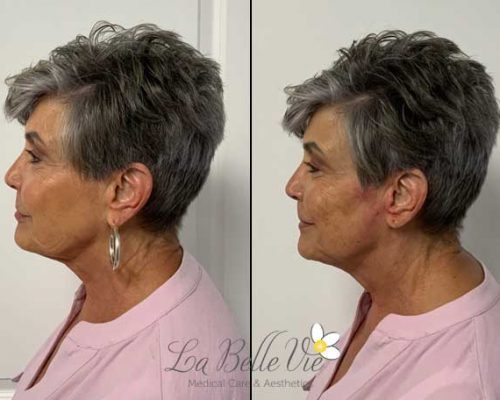 PDO Thread Before and After Photos | La Belle Vie Medical Care & Aesthetics In Draper, UT