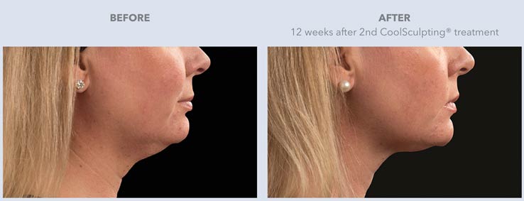 kybella-double-chin Before & After Treatment result results in Draper, UT | La Belle Vie Medical Care and Aesthetics
