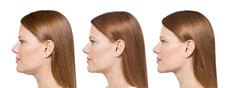 Kybella-double-chin-results in Draper, UT | La Belle Vie Medical Care and Aesthetics