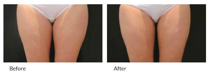 la belle vie coolsculpting inner thigh before after