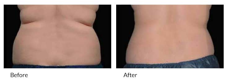 la belle vie coolsculpting man flank before after