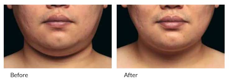 la belle vie coolsculpting man front chin before after