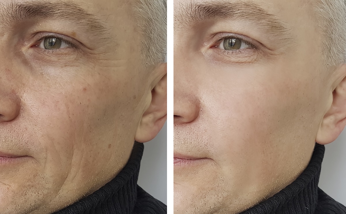 man-wrinkles-before-and-after-La Belle Vie Medical Care & Aesthetics | Draper, UT