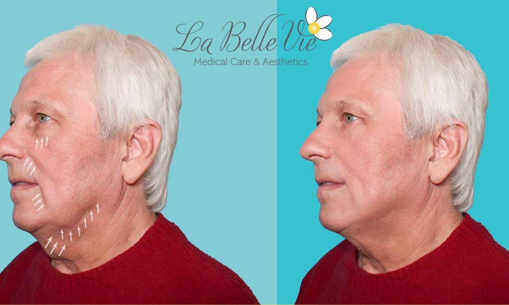 PDO Thread Lifts For Men Before and After Photos | La Belle Vie Medical Care & Aesthetics In Draper, UT