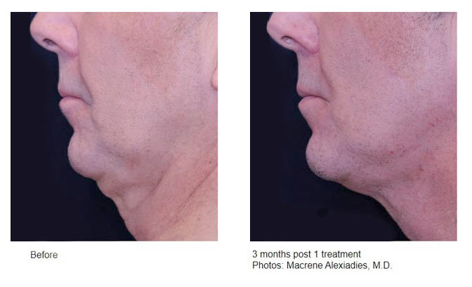 profound clinical results man chin