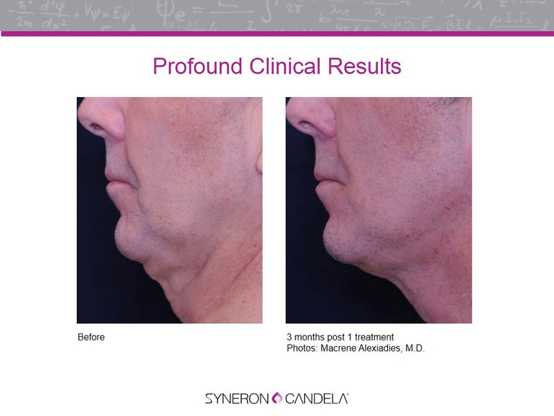 skin treatment profound Facial and Utah Treatment Treatment Profound Skin Tightening